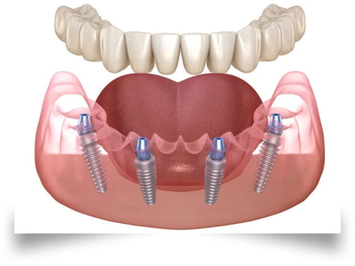 ALL ON FOUR Implante dentário - All on four