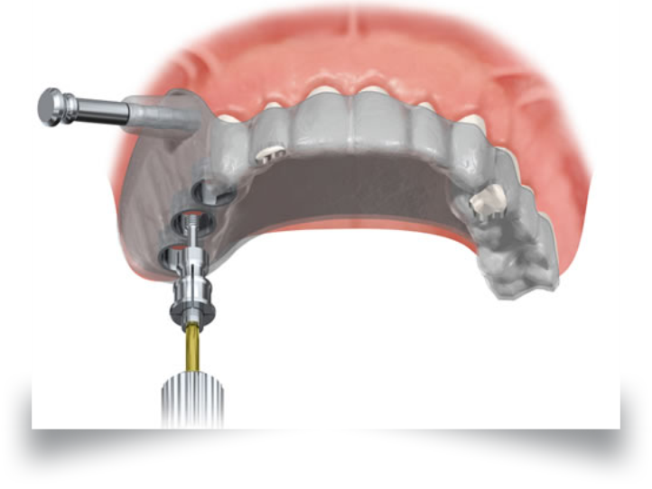 cirurgia guiada Cirurgia guiada